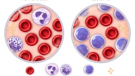 Leukemia