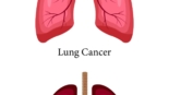Lung Cancer
