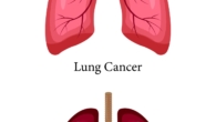 Lung Cancer