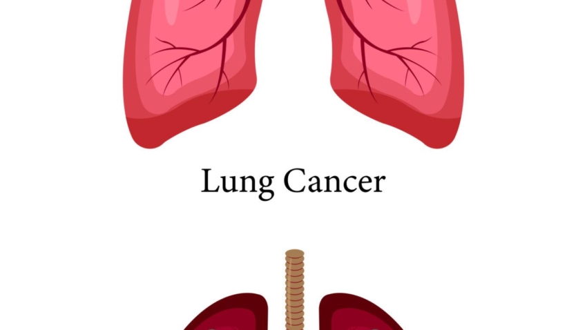 Lung Cancer
