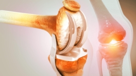 Osteoarthritis