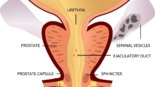 Prostate Cancer