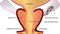 Prostate Cancer