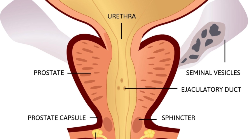 Prostate Cancer