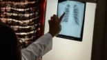 Tuberculosis