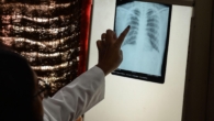 Tuberculosis