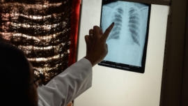 Tuberculosis